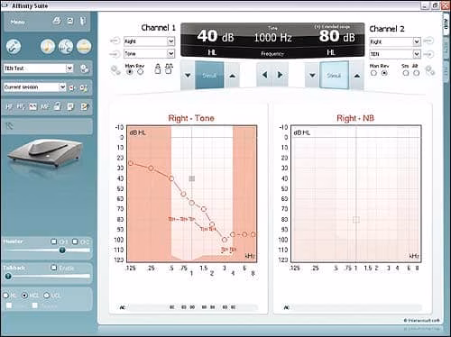 Тест Фаулера (SISI)